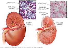 What is Kidney Disease?