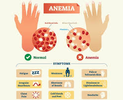 Tips to Prevent Anemia