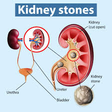 What are Renal Stones?