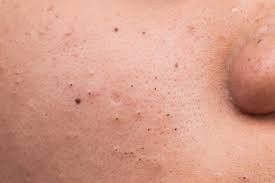 Black Head