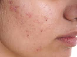 Acne (pimples)