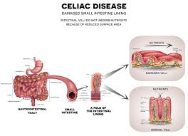 How to diagnose Celiac disease