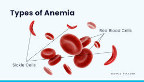 Types of Anemia