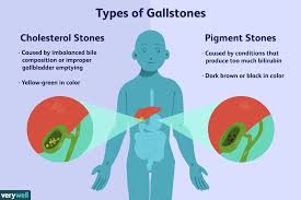 Types and Causes of Gall Bladder Stone