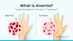 What is Anemia?