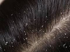 Dandruff