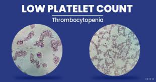 Low Platelets Count